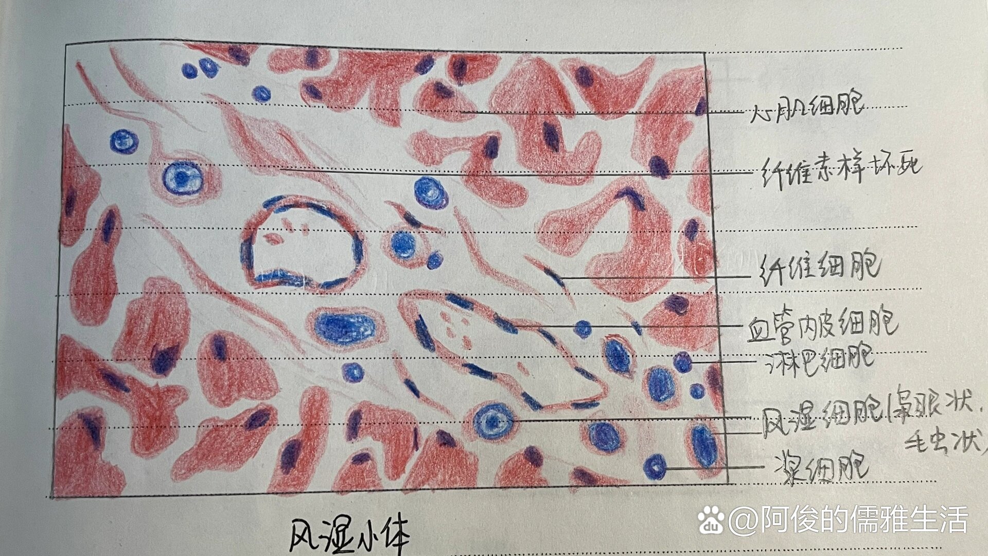 病理切片红蓝铅笔✏️图1⃣️风湿小体2⃣️
