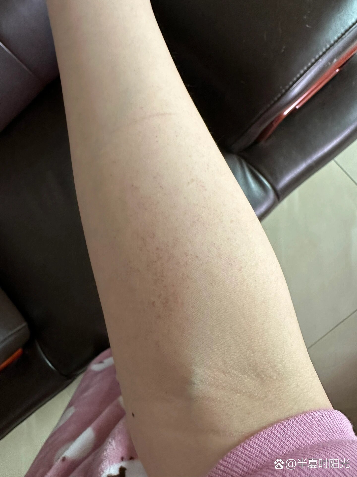 皮下出血00小红点
