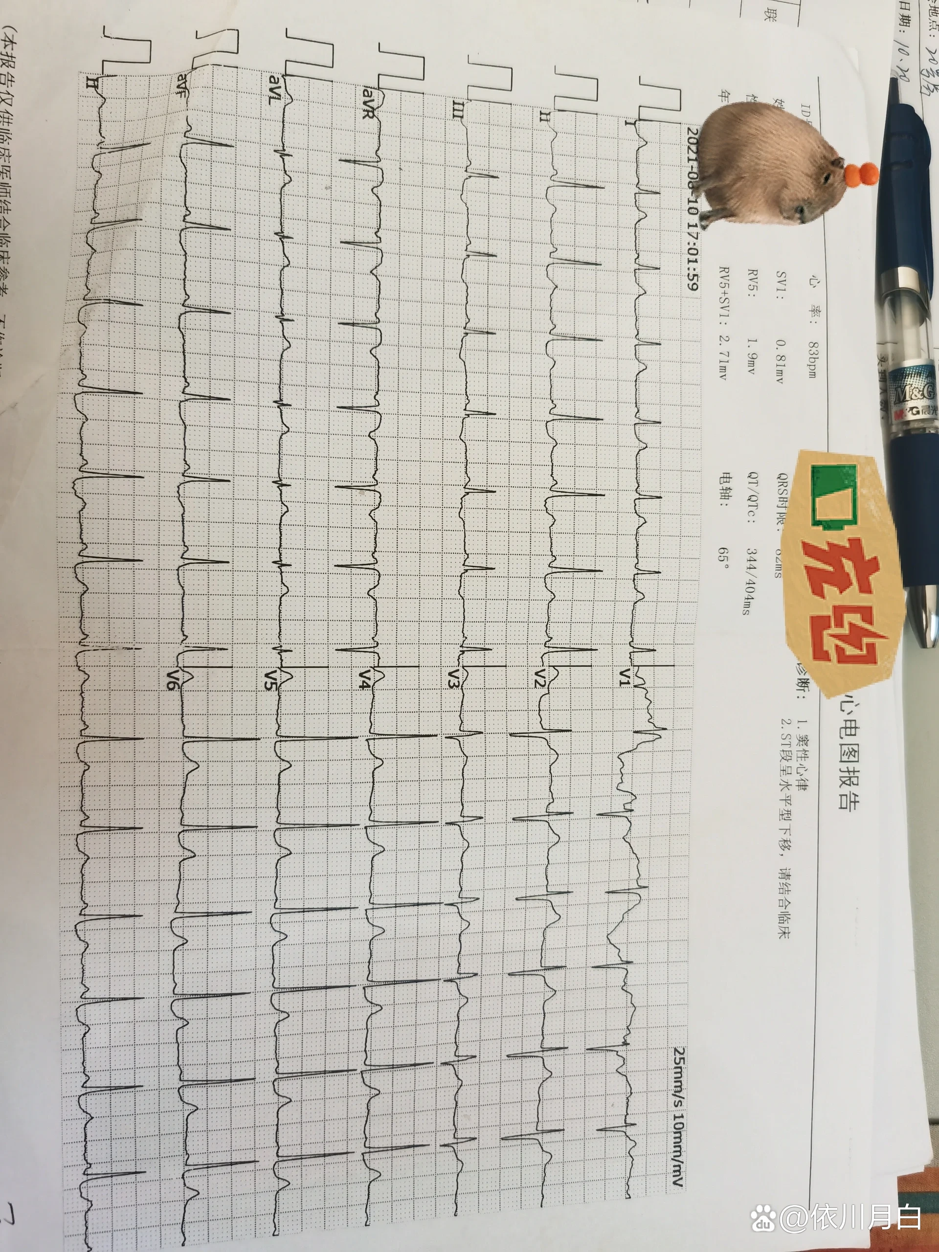 心电图10mmmv25mms50hz图片