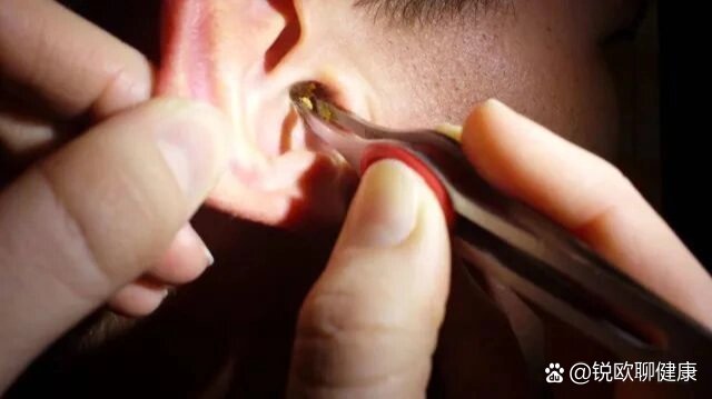  p>耵聍栓塞的表现 br>当发生耵聍栓塞之后,通常会出现下列症状:  br>