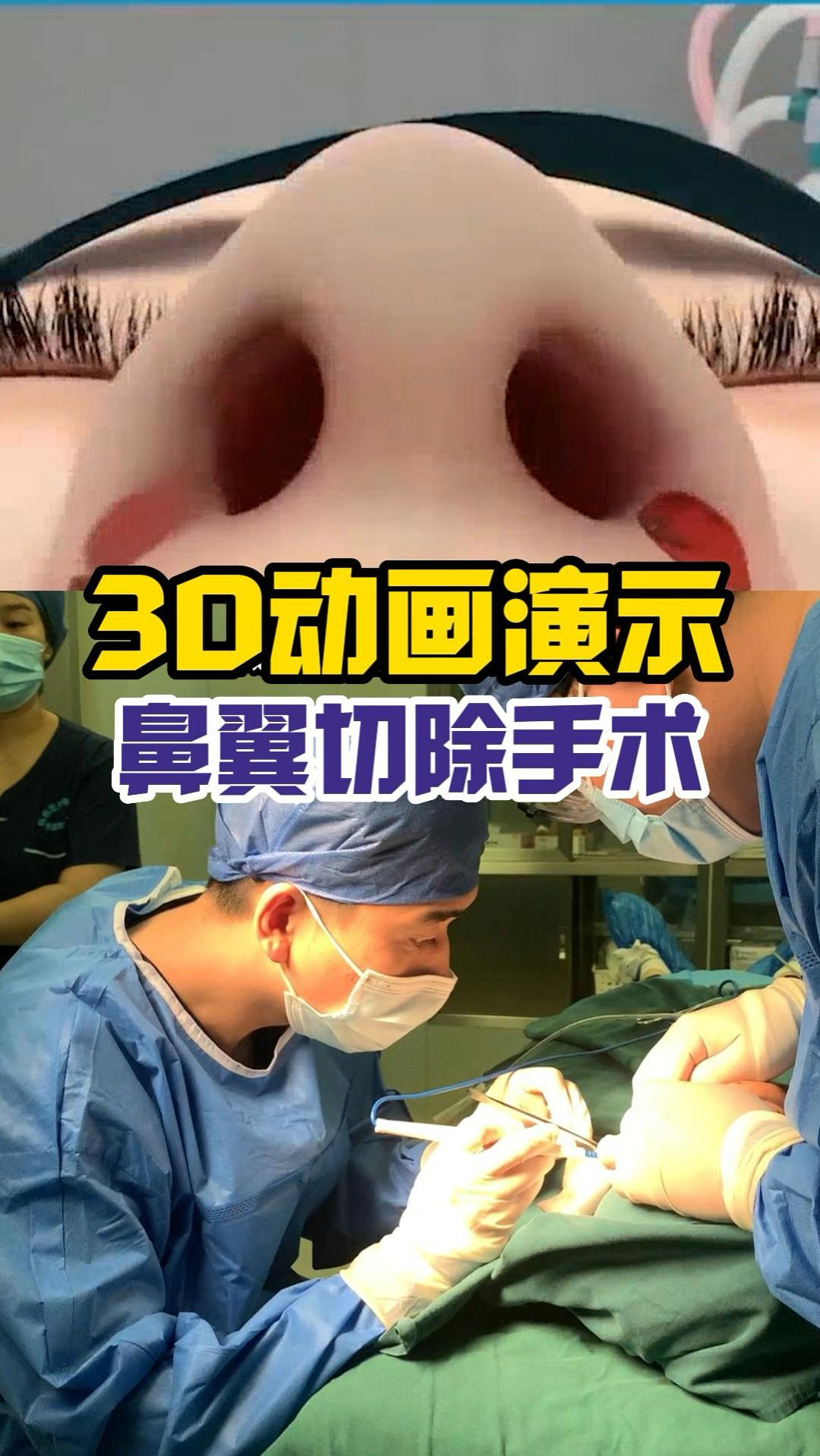 3d动画演示鼻翼缩小手术
