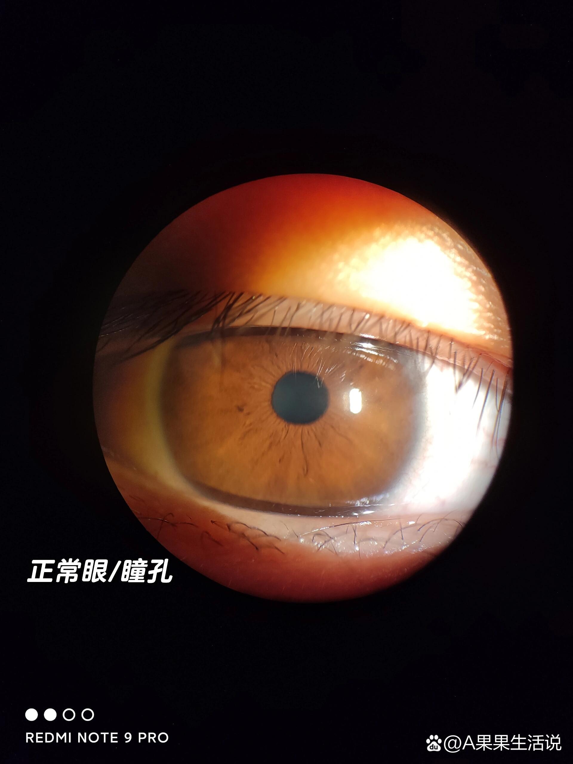 一图认识白内障