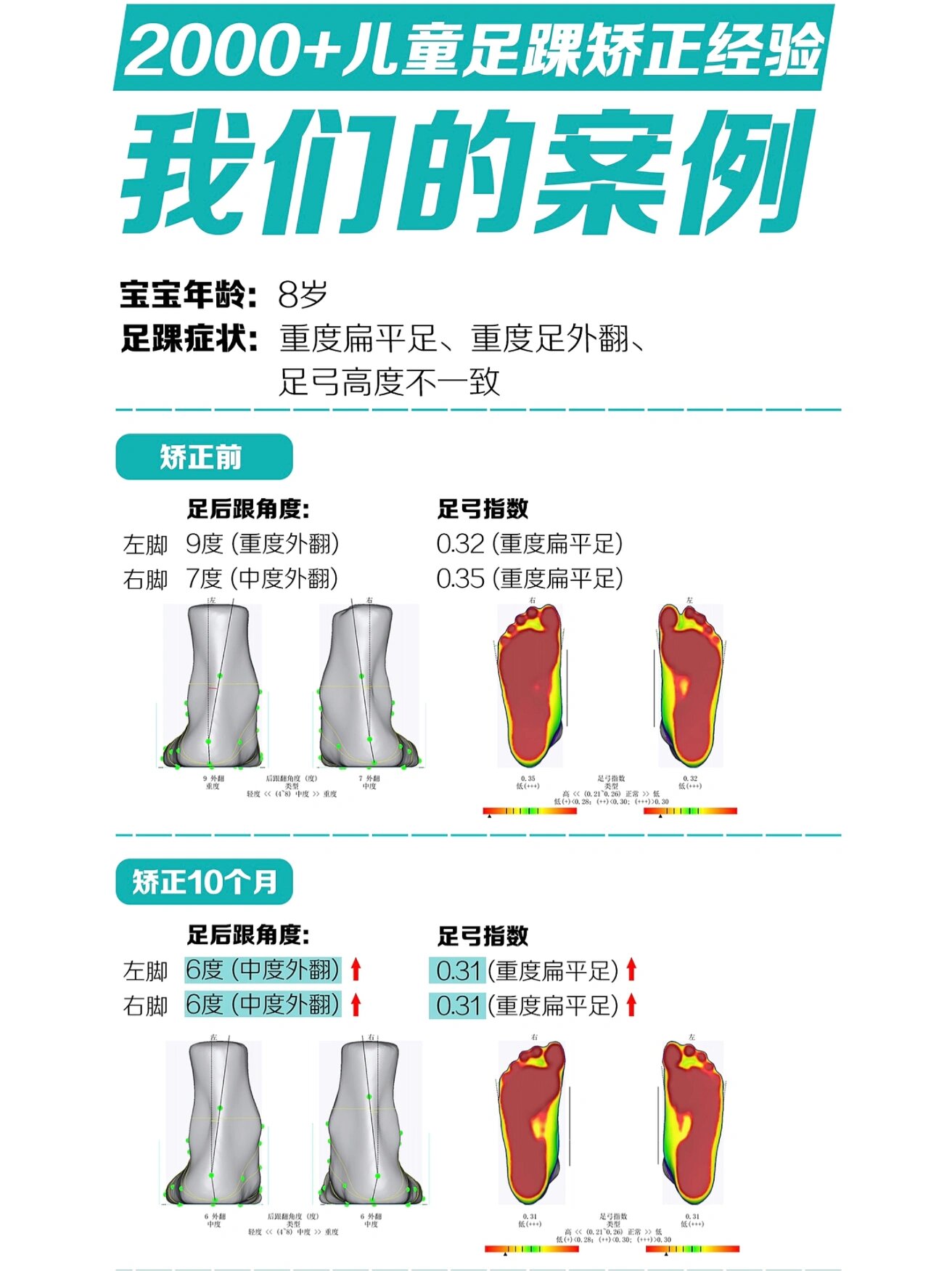 足踝外翻矫正方法图片