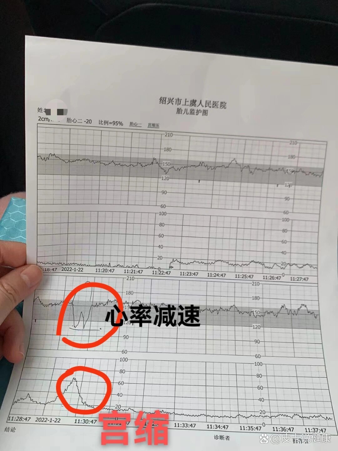 心率早期减速(很危险的一个信号)  br>看图:宫缩时候直接胎心掉下来