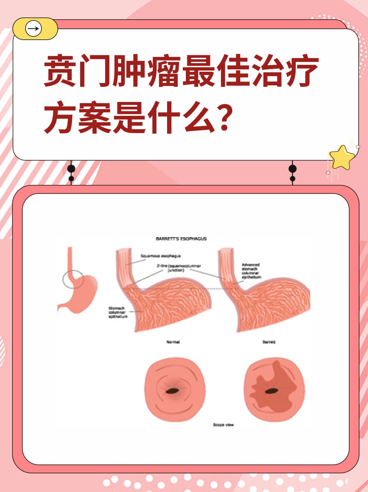 贲门癌治愈率图片