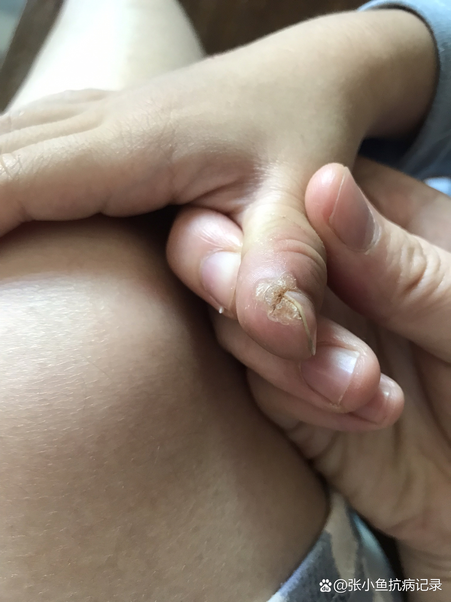 甲周疣治疗第十一天