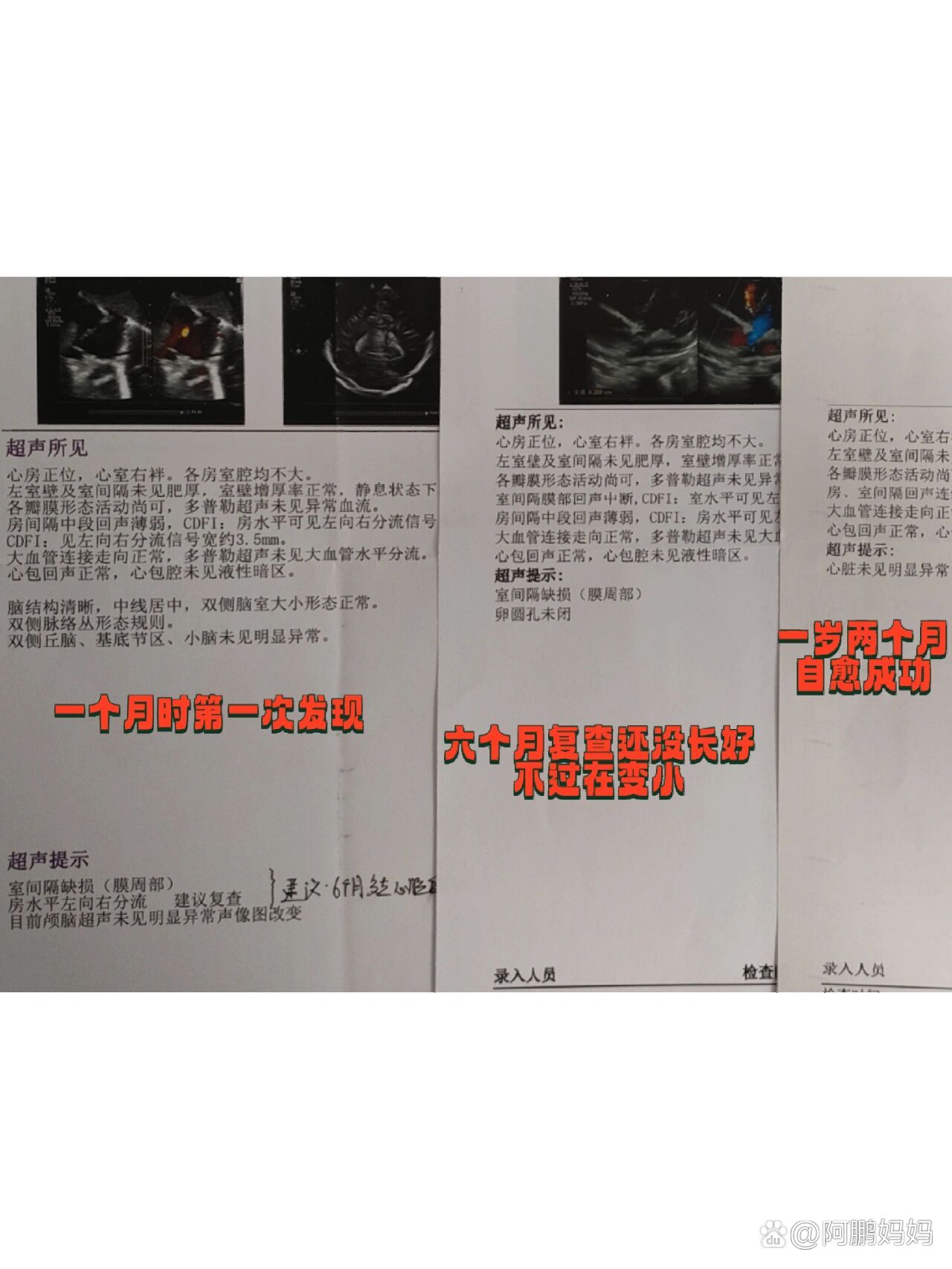 新生儿房间隔缺损4mm图片