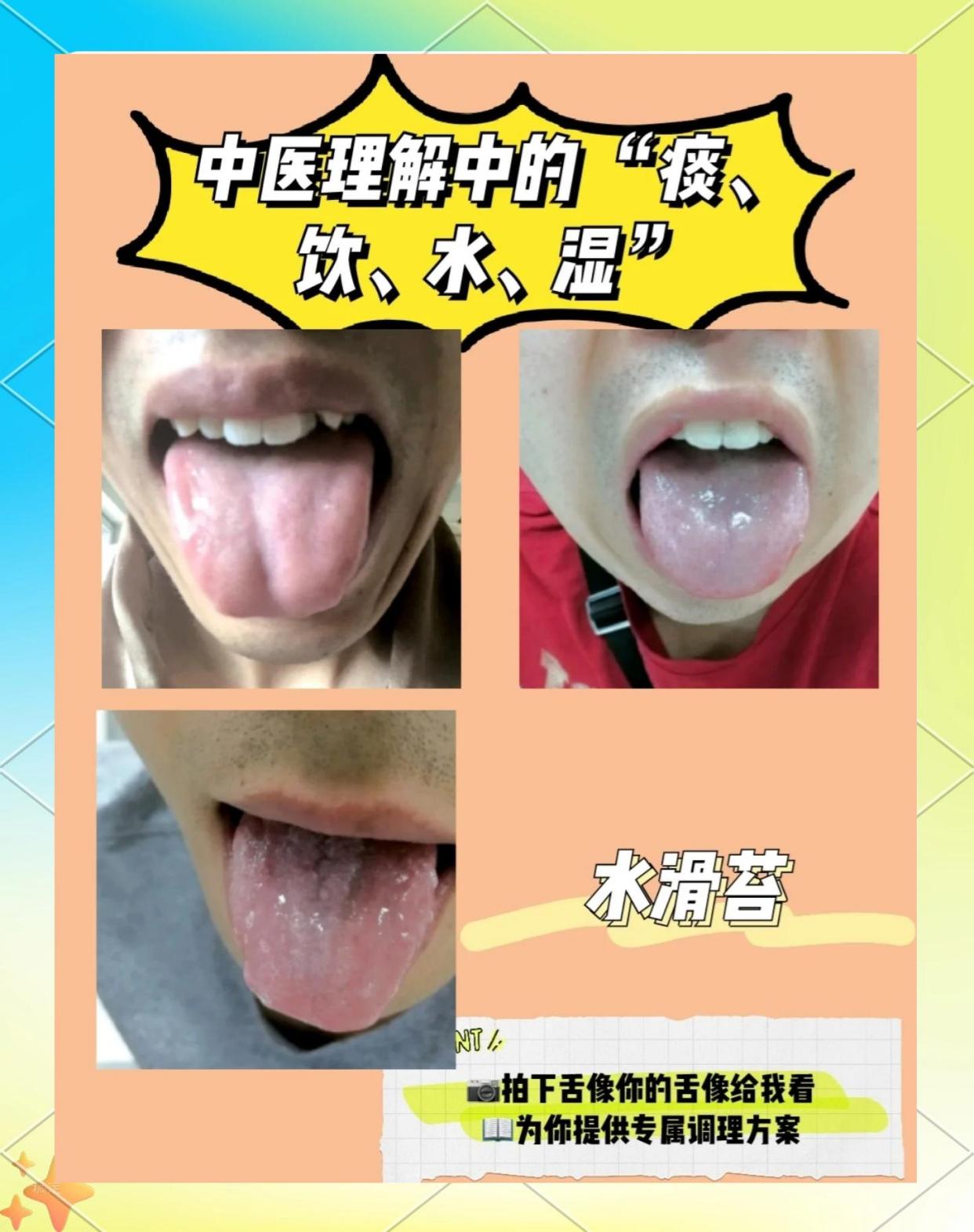 💧中医眼中的“痰、饮、水、湿”