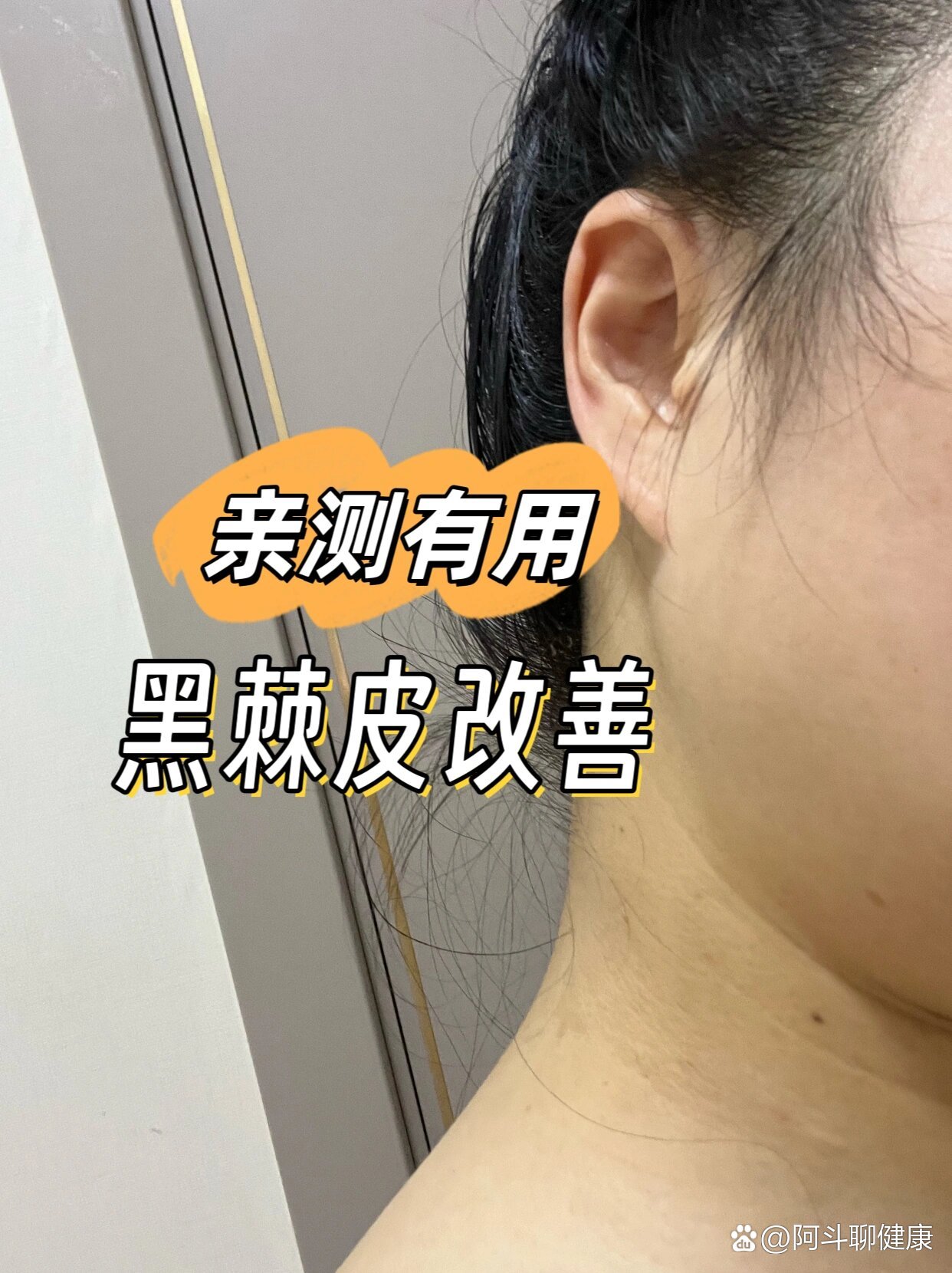 亲测有用的黑棘皮改善方法