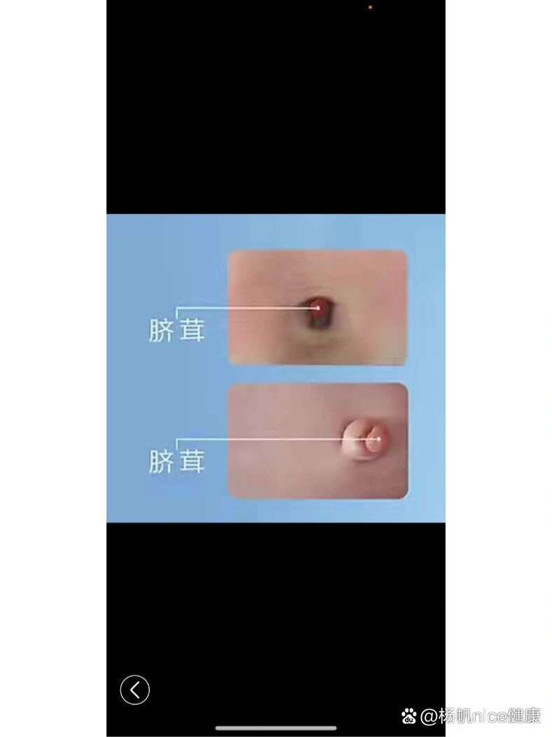 新生儿 脐茸篇🌈出院后两周➕满月检查发现肚脐有个红色的