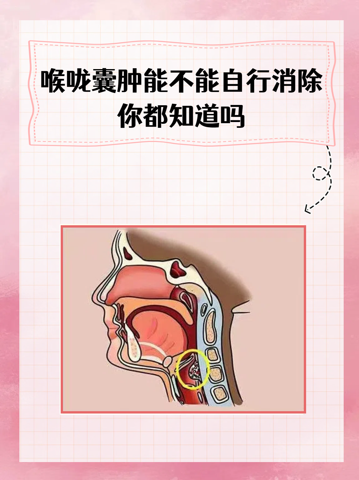 咽喉囊肿严重吗图片