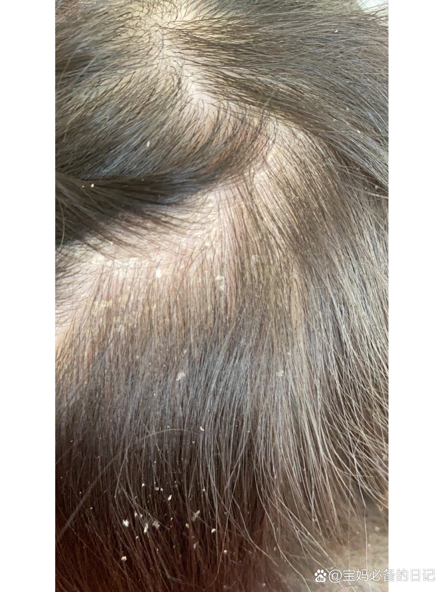 小孩子为什么有头皮屑为什么在线