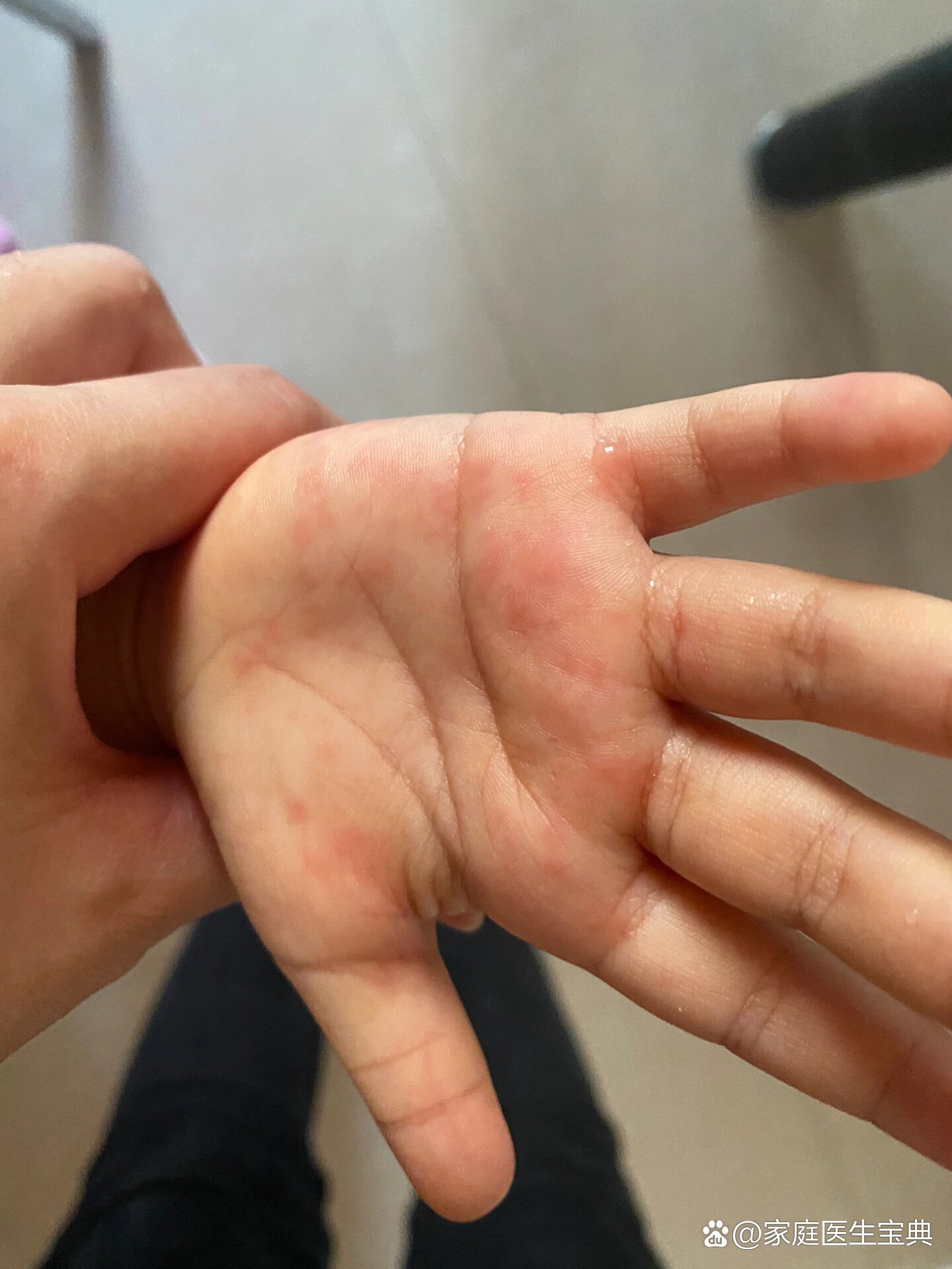 宝宝手心红点还痒,是什么问题?
