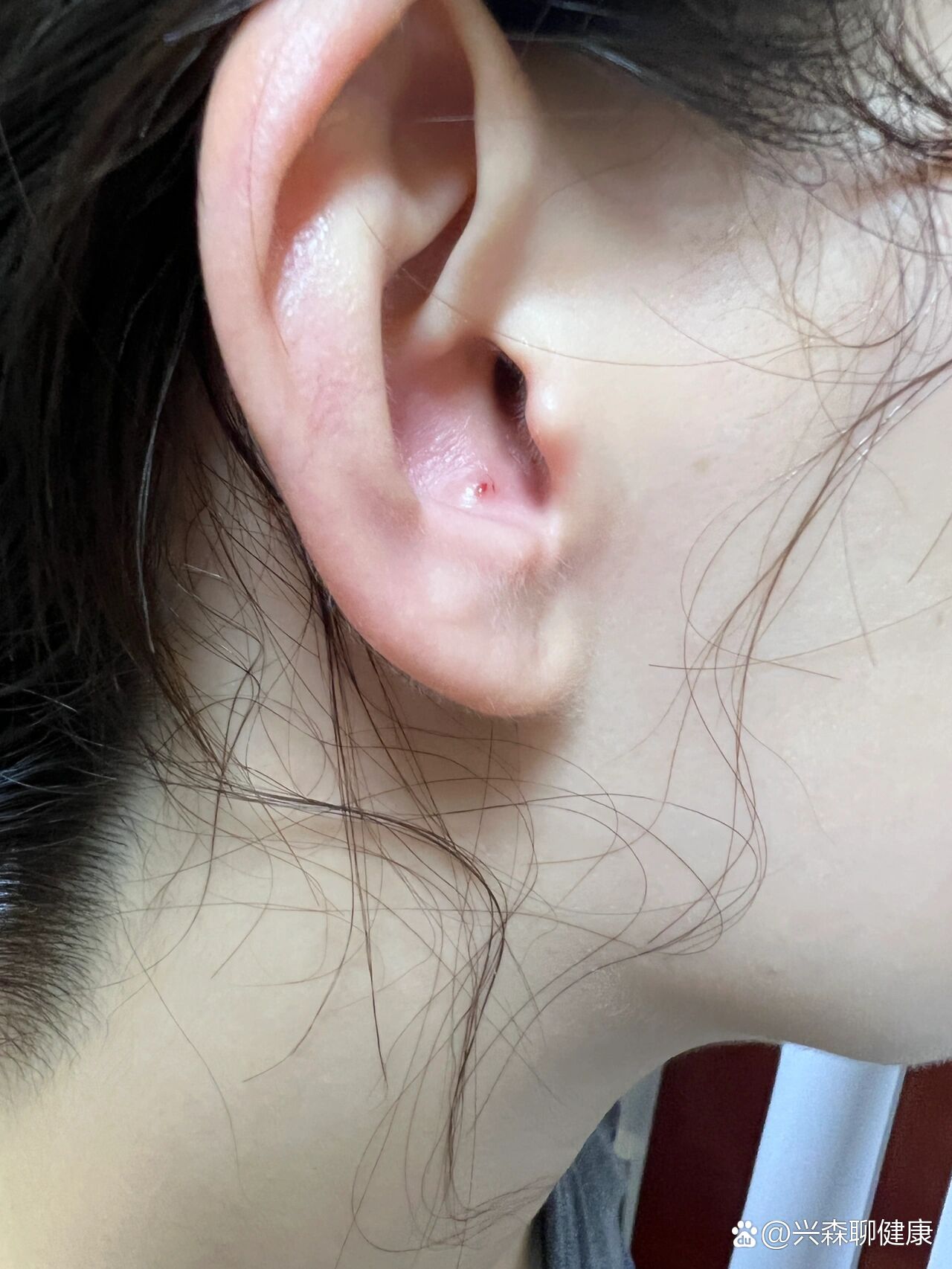耳朵里长痘痘