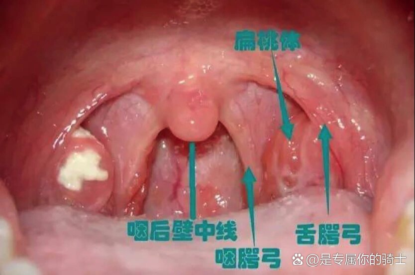 关于扁桃体肿大