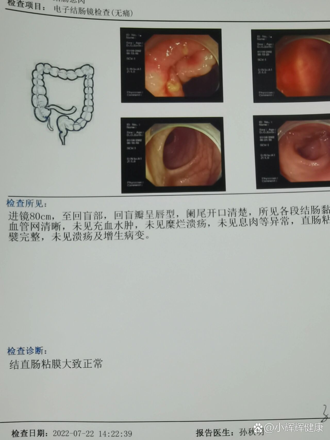 预约肠镜还需要挂号吗(预约肠镜检查需要本人去吗)