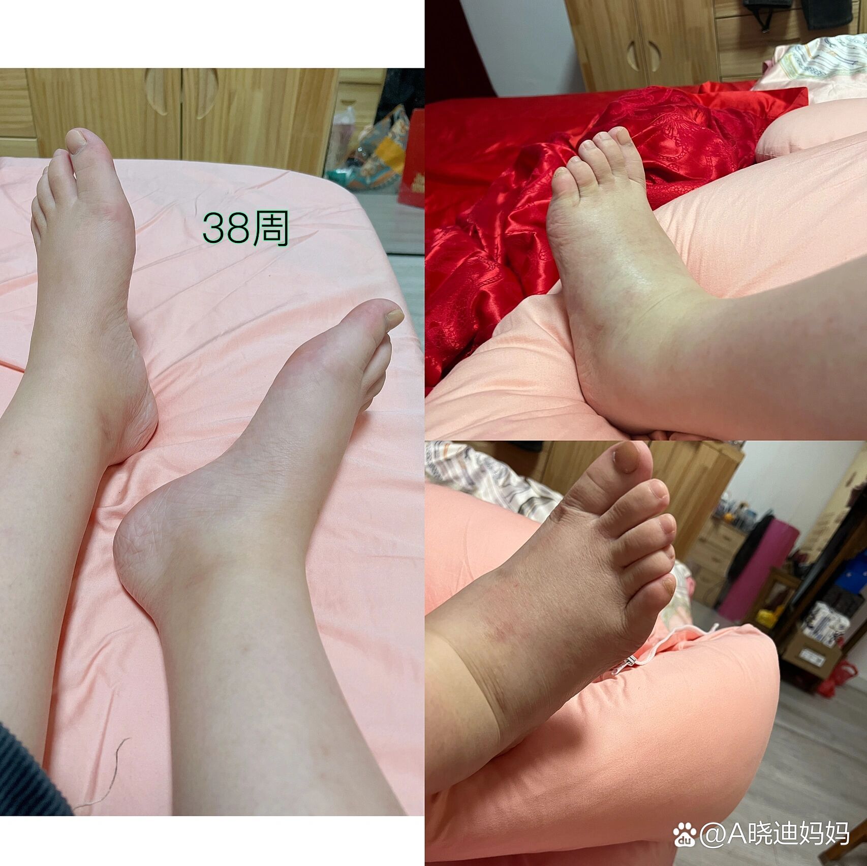 大腿肿照片图片