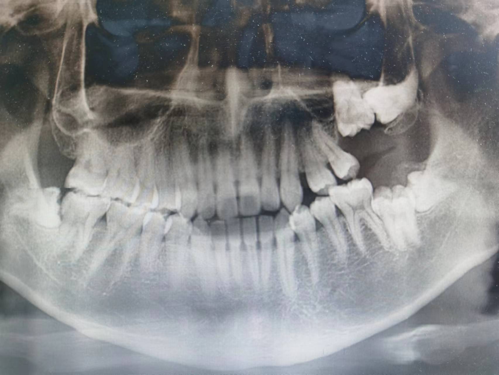 叠摞式舌向阻生下颌磨牙拔除术1例-德医学院-助力医学教育发展！
