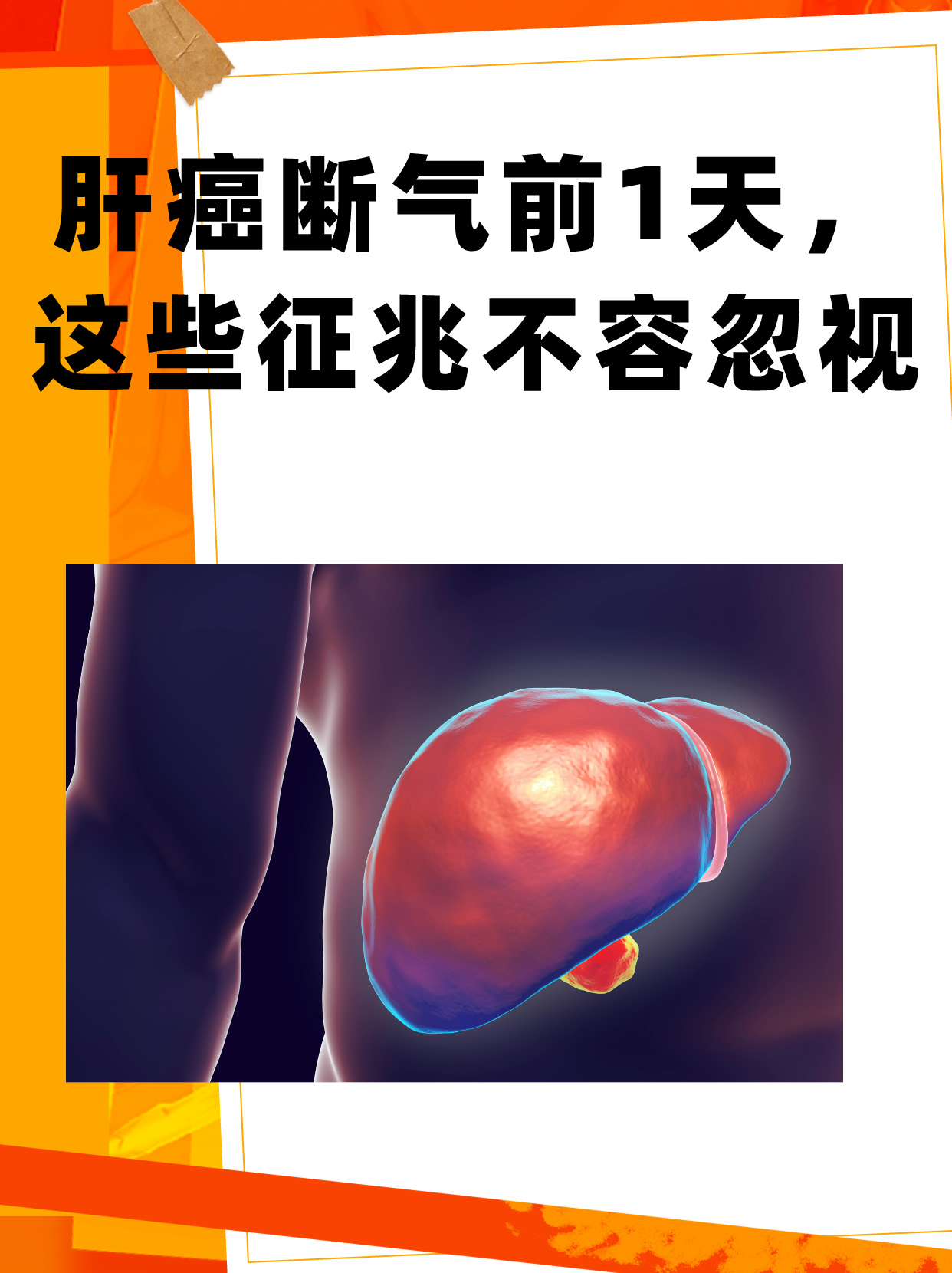 肝癌断气前1天,这些征兆不容忽视