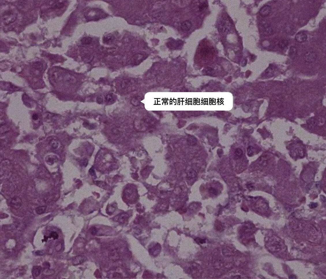 医学实验课Ⅰ病理学实验之肝细胞坏死