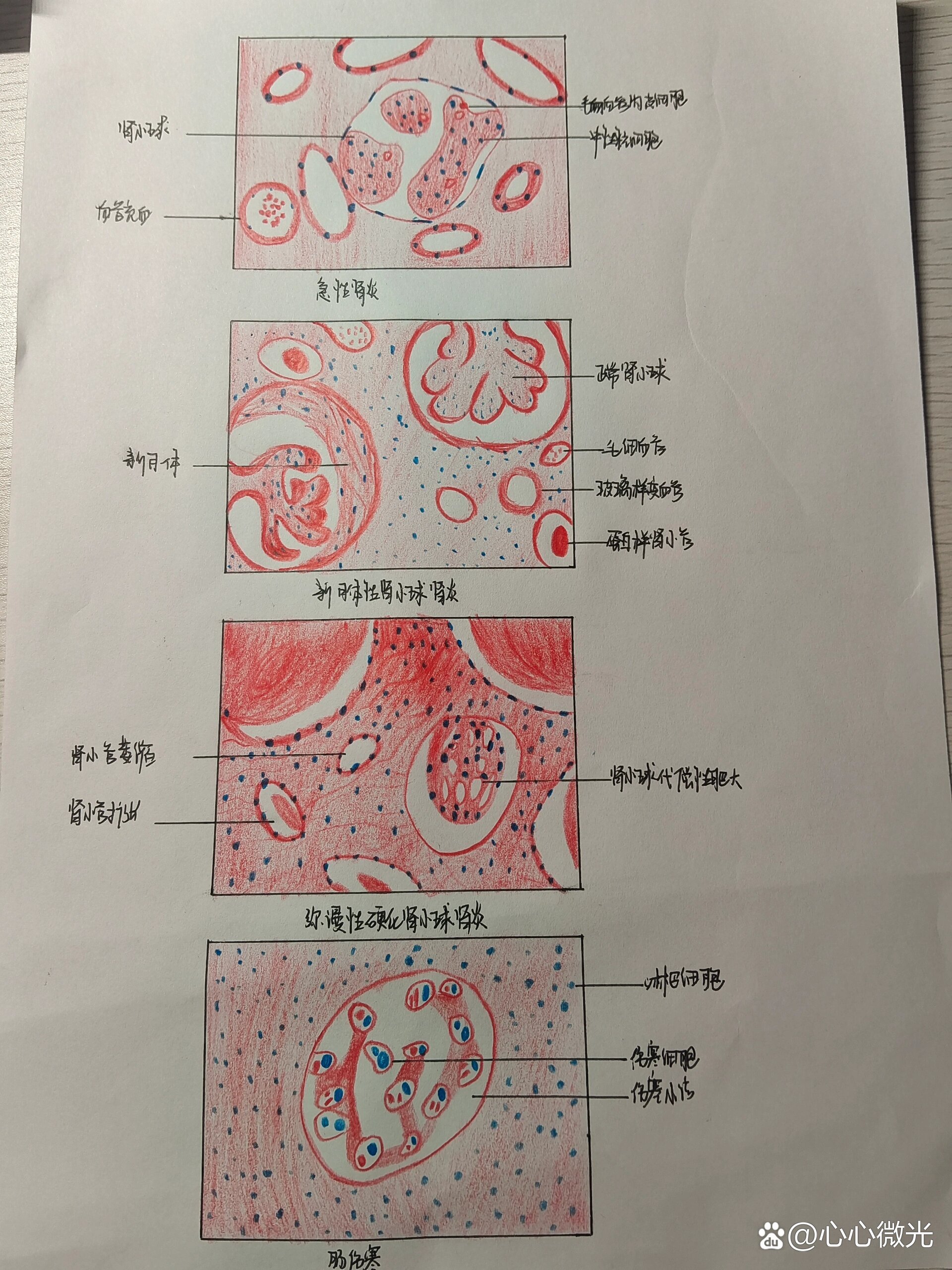 肾凝固性坏死手绘图图片