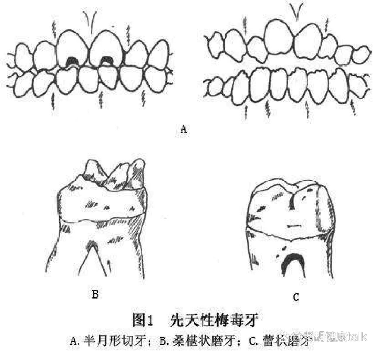 梅毒牙齿半月形的图片图片