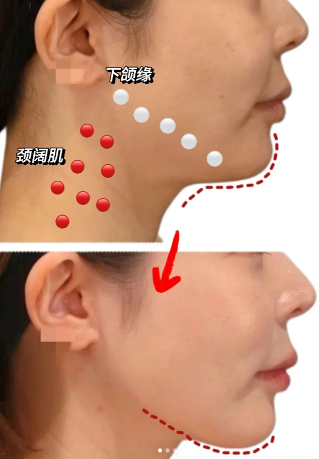 记住这些肉 毒小tips,直接整个提升面中!