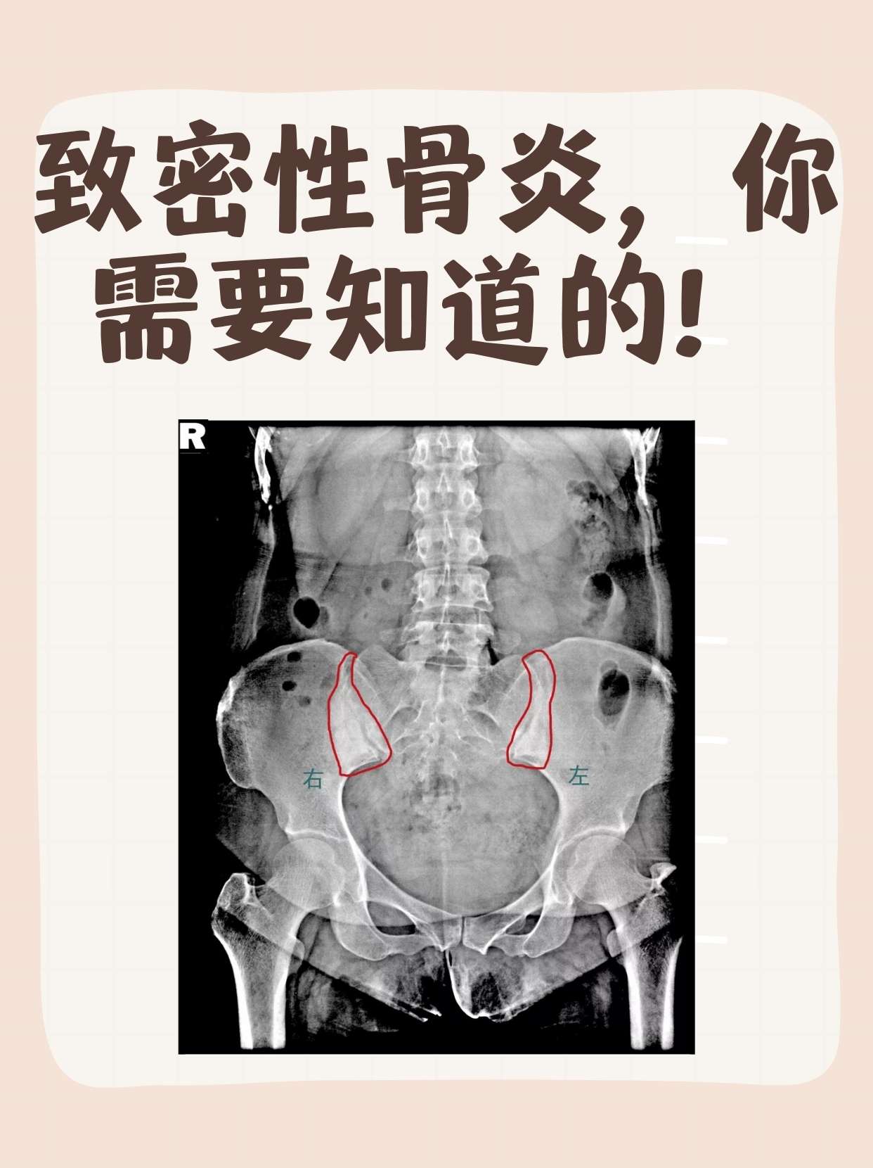 下颌骨致密性骨炎图片图片