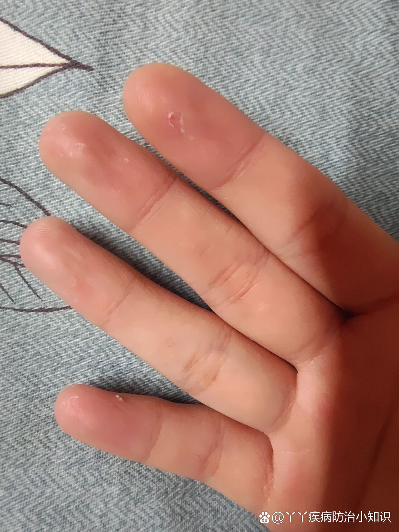 求助,手指头上有白色的小泡泡是怎么了