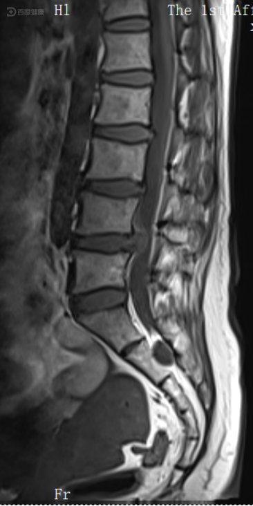 骶管囊肿图片 磁共振图片