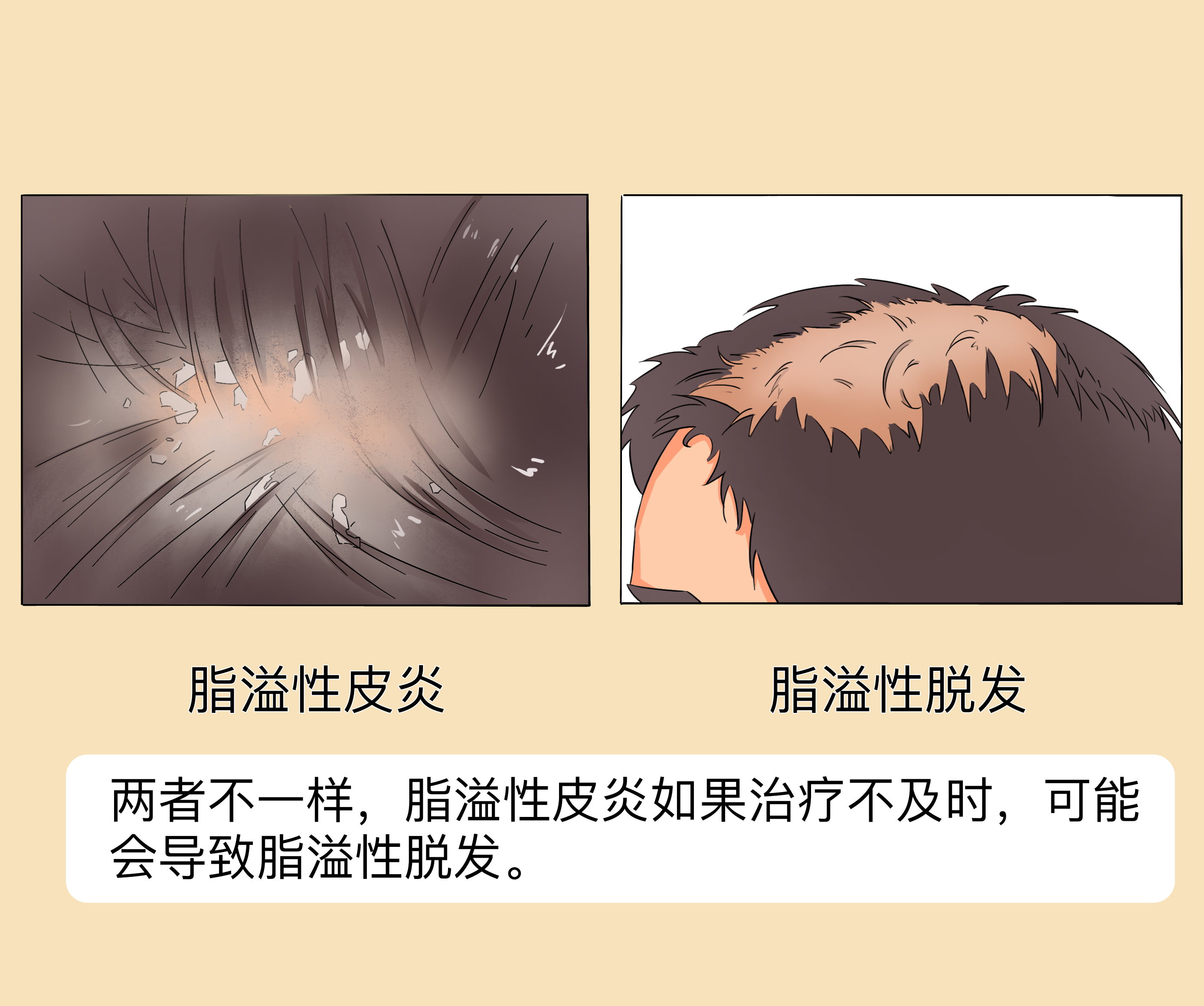 脂溢性皮炎和脂溢性脱发一样吗