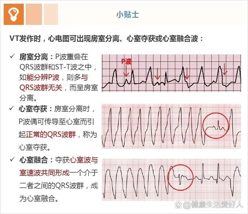 短阵室速的心电图特征图片