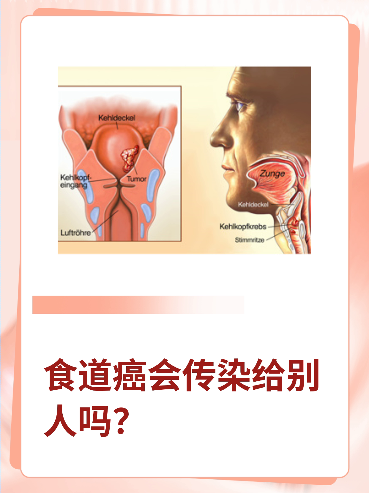 食道癌会传染吗图片