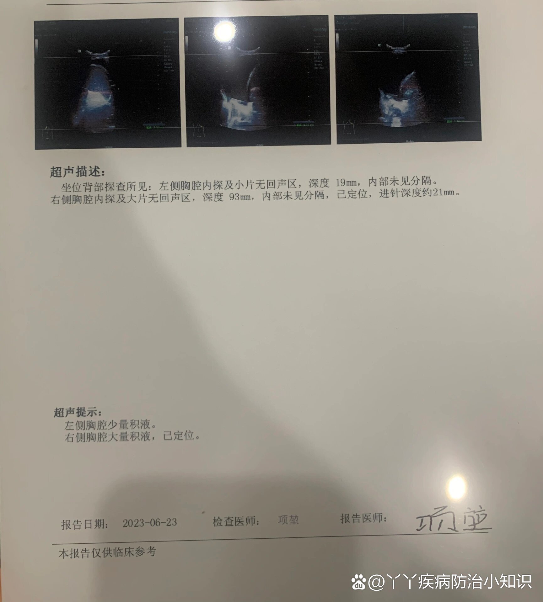 不明原因的胸腔积液