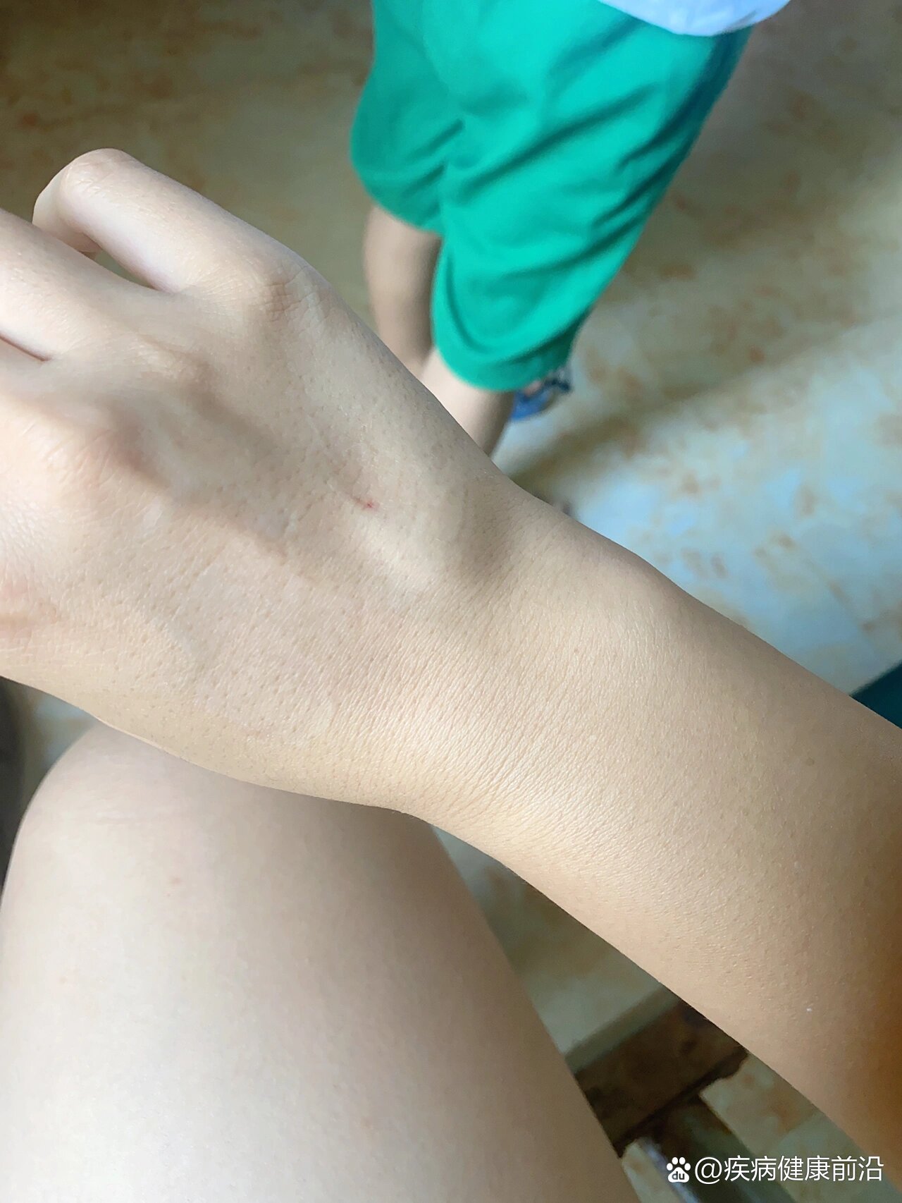 吊瓶后鼓包是什么原因?