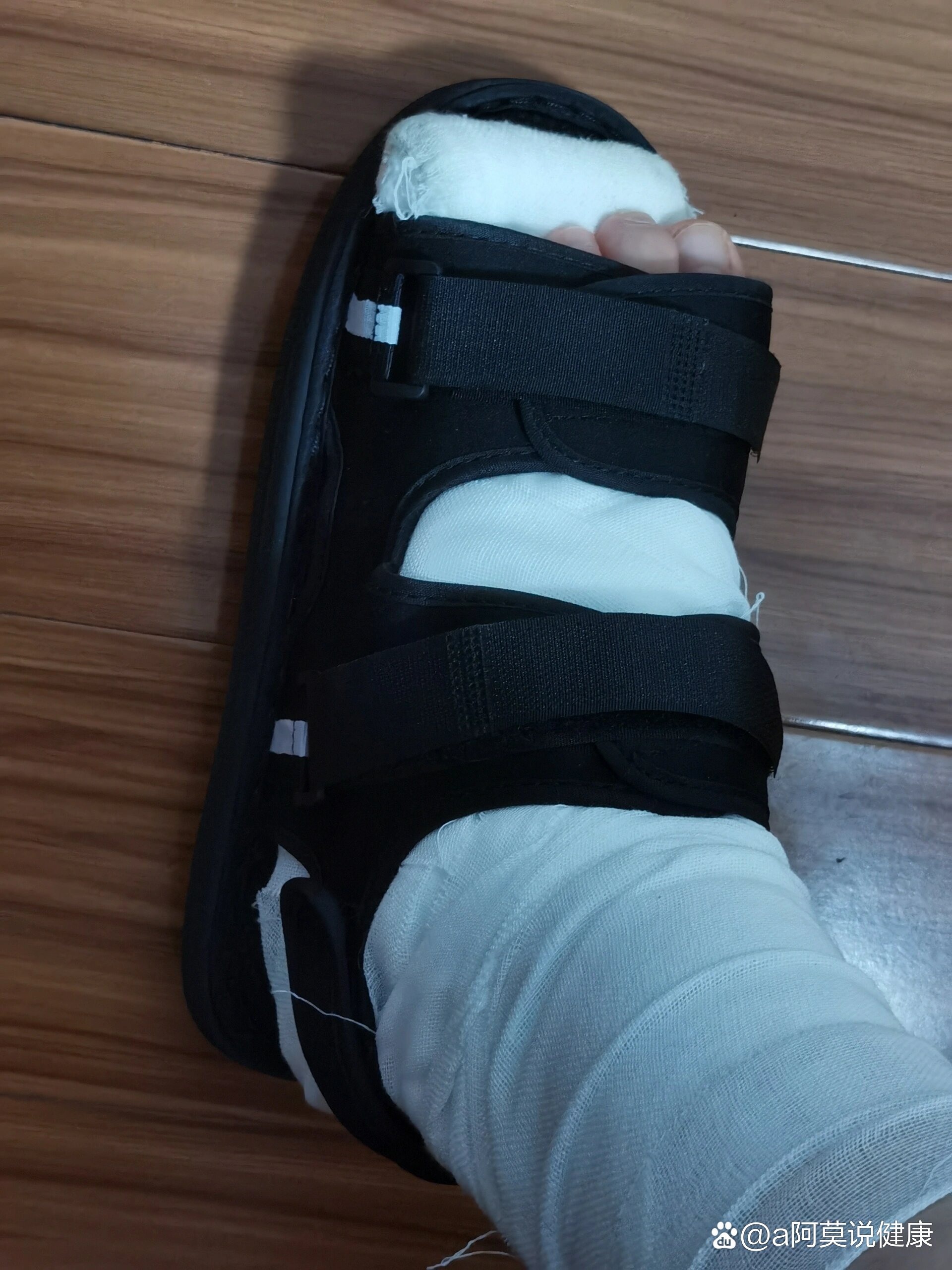 跖骨骨折之好物推荐:骨折鞋