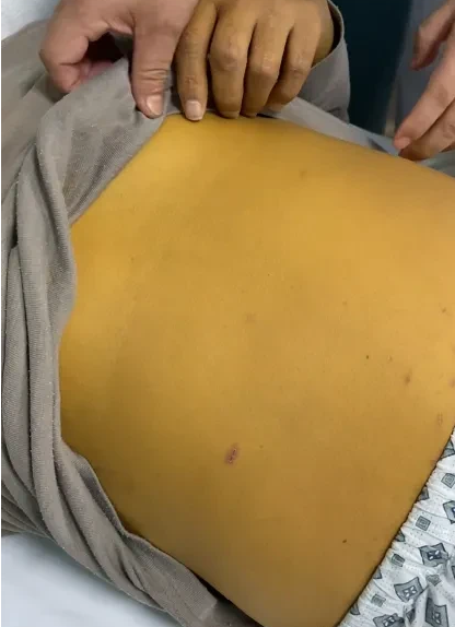 肝硬化肝功能失代偿期时有哪些表现?