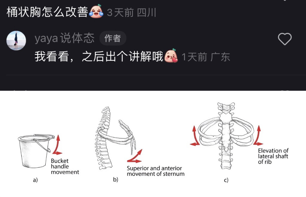 儿童桶状胸图片