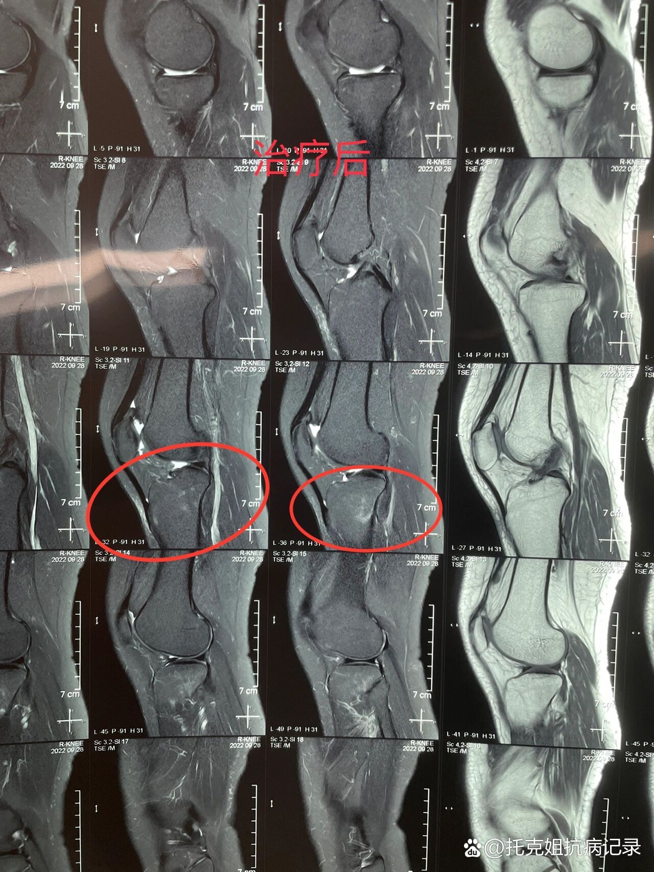 入院时核磁提示股骨内侧髁骨髓水肿,关节积液,半月板1度损伤