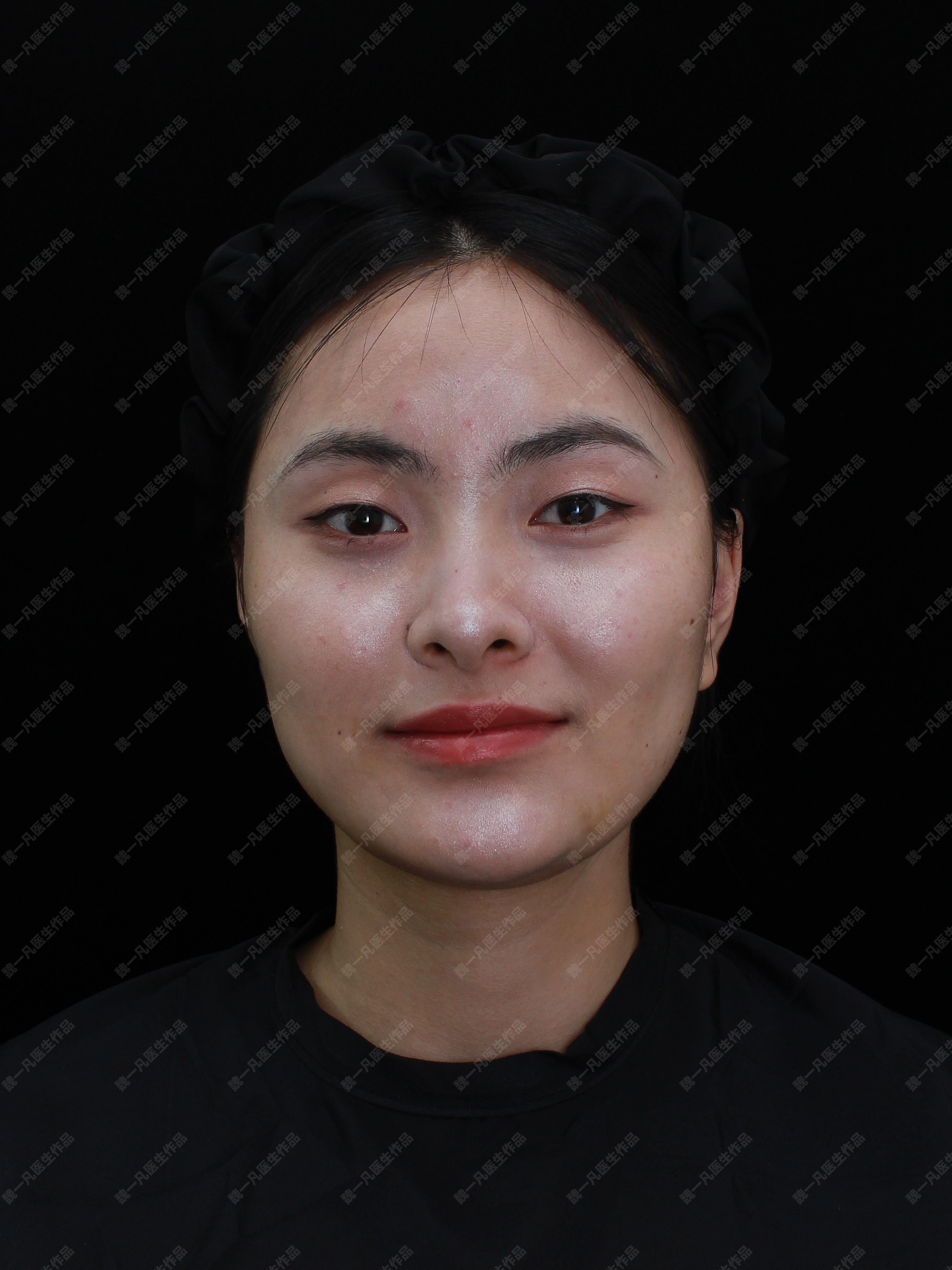 颧弓突出面相凶,玻尿酸填充重回温婉小姐姐