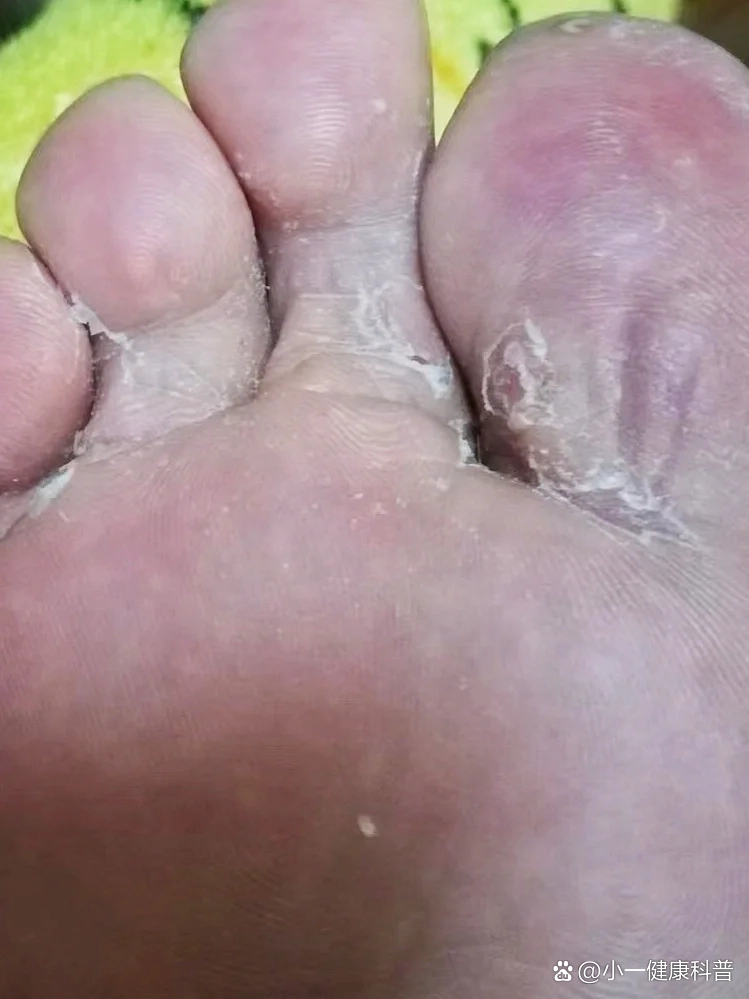 烂脚丫子…啥时候是个头啊