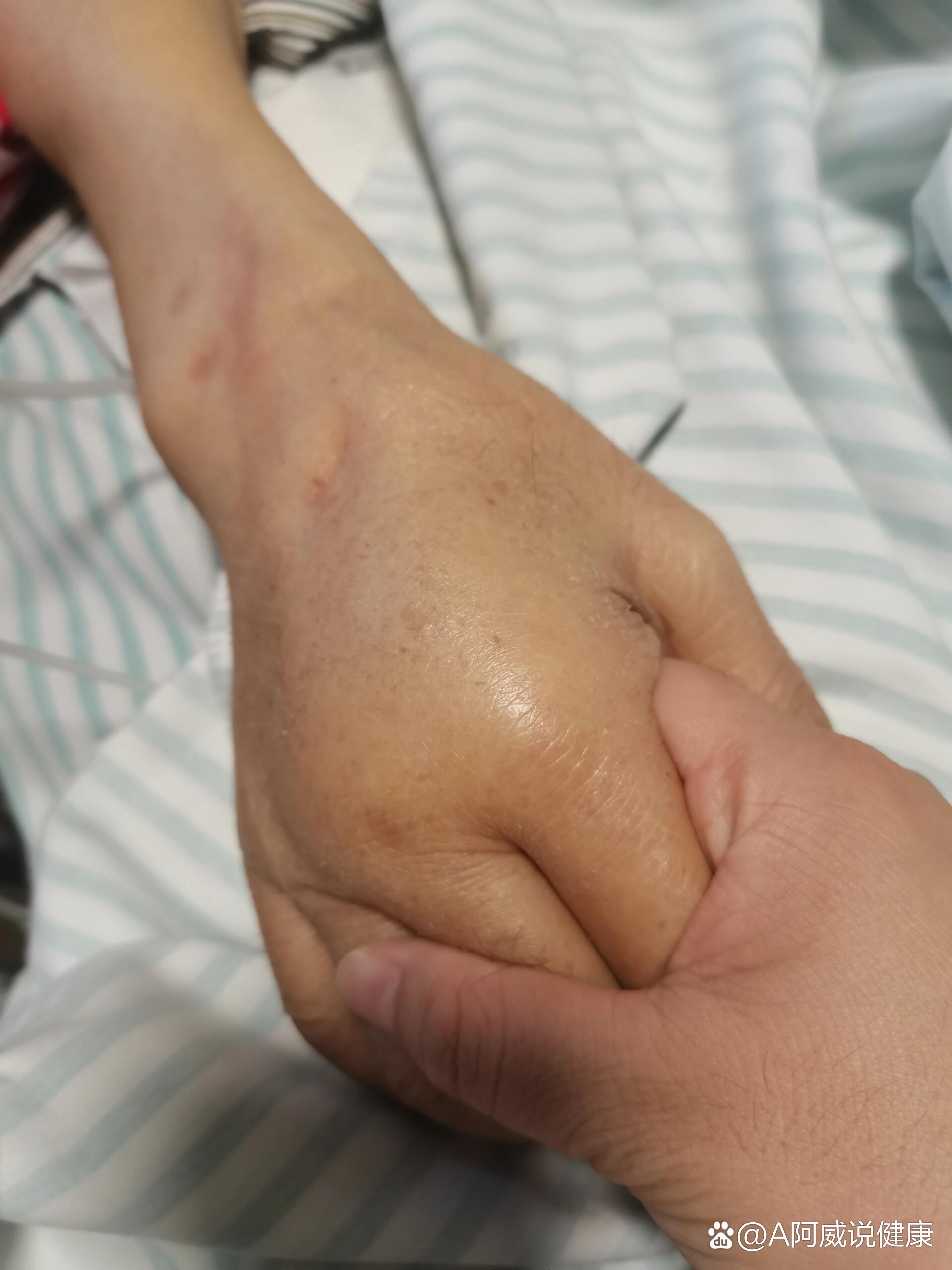 肺癌终末期～水肿,发烧,心率快(中秋节)