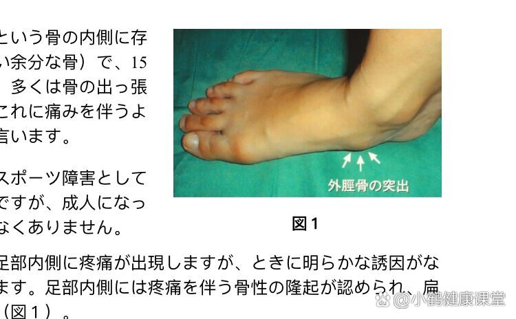 芭蕾常见损伤·假外开导致脚部舟状骨突出