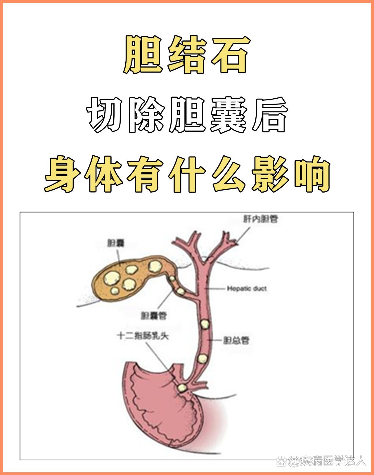  p>胆结石,割胆对身体有什么影响 br>胆囊结石的患者,切除胆囊是现在