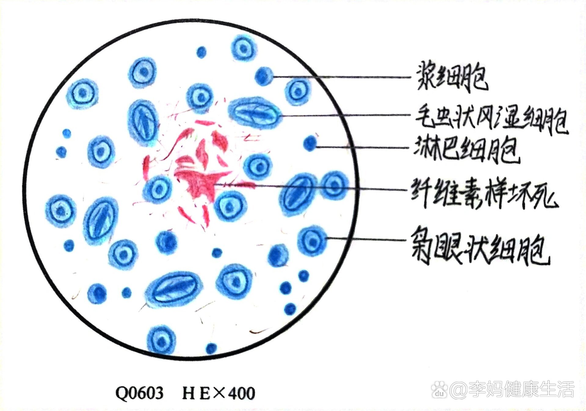 风湿小结图片图片