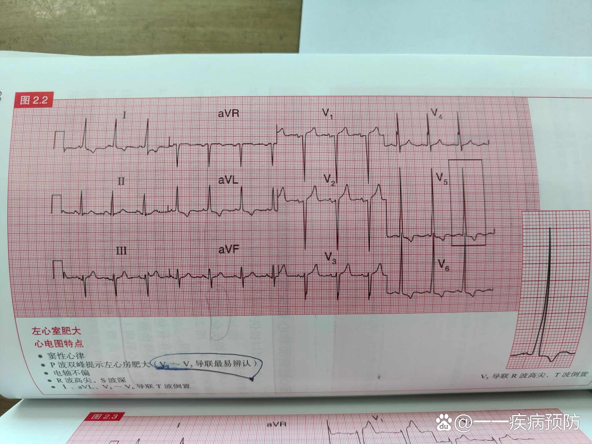 左心房肥大的心电图图片