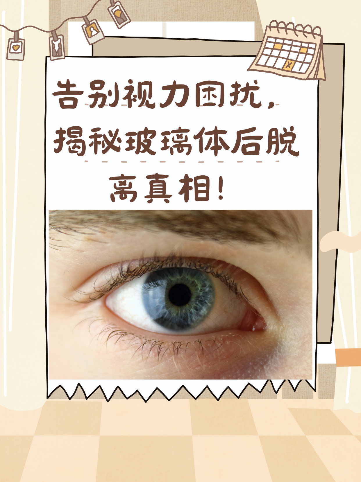 玻璃体后脱离,我的眼睛发生了什么?