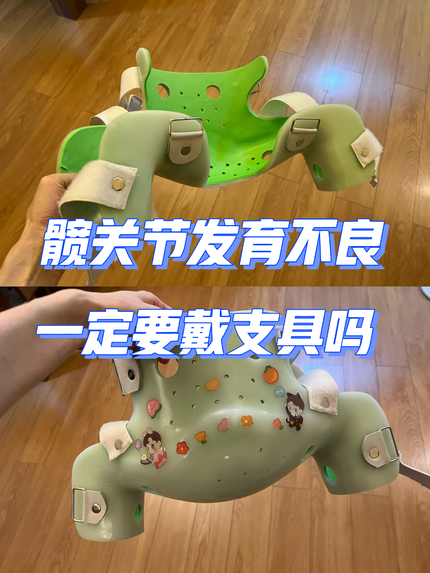 髋关节发育不良一定要带支具吗?