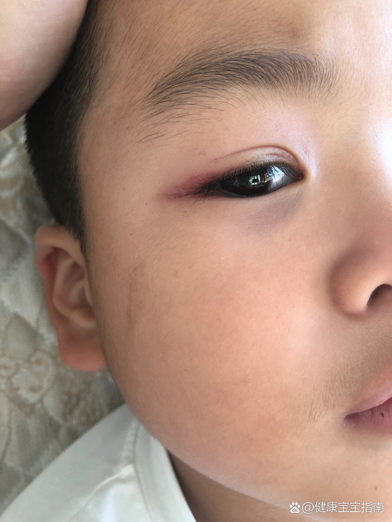 孩子玩耍扎眼睛了