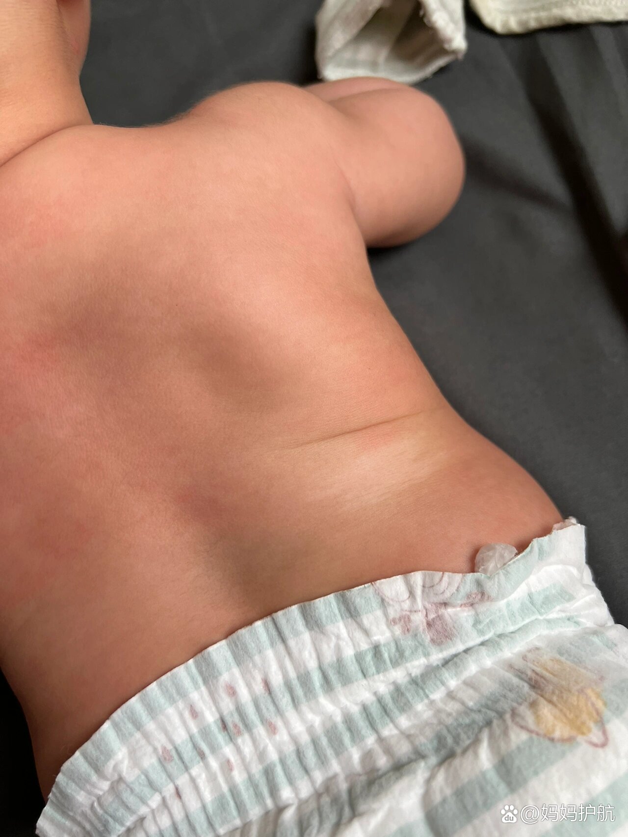 发现宝宝身上有一块白斑